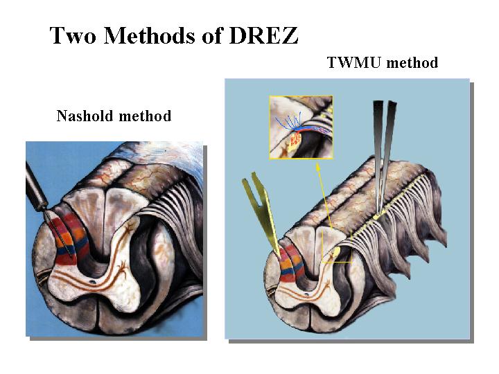 痙縮に対する後根進入部遮断術 Dorsal Root Entry Zono Tomy Drez Tomy